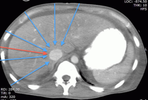 CT liver IVC views
